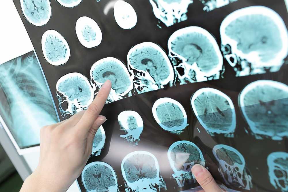 Chirurgii laser diferențiază țesutul cerebral canceros / Știri despre sănătate