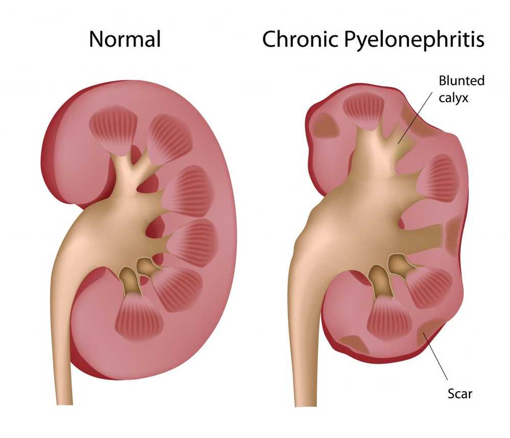 Kronisk pyelitt / sykdommer