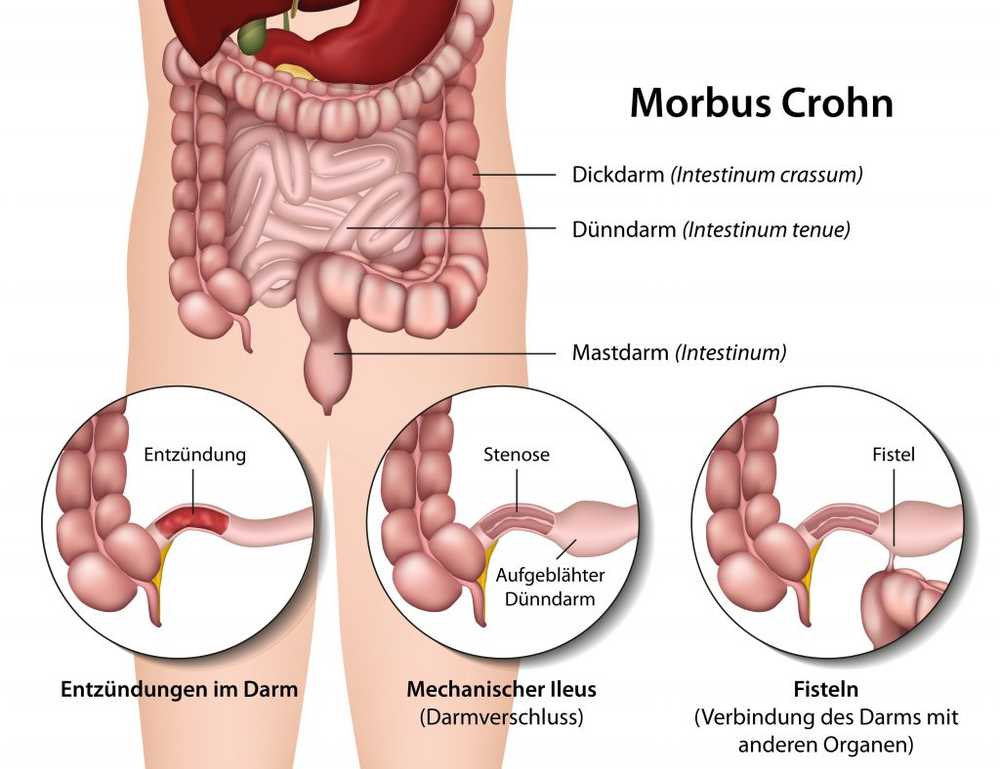 Kronisk tarmsykdom En sopp som sannsynligvis utløser Crohns sykdom / Helse Nyheter