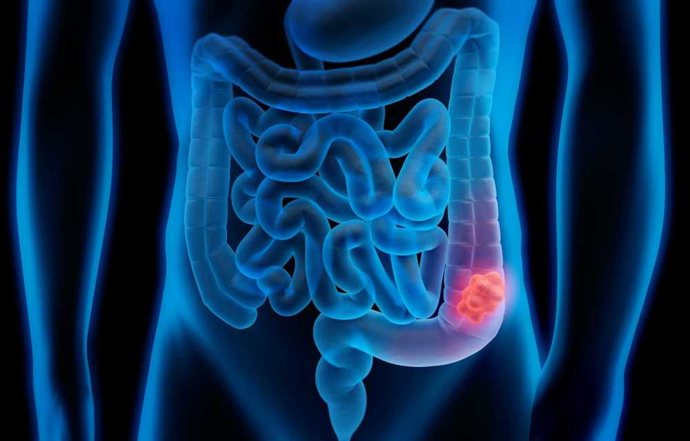 Colorectal cancer new cases reduced by 14 percent across Germany / Health News