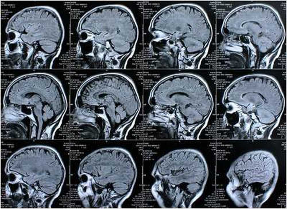 Dépression due à une inflammation du cerveau / Nouvelles sur la santé