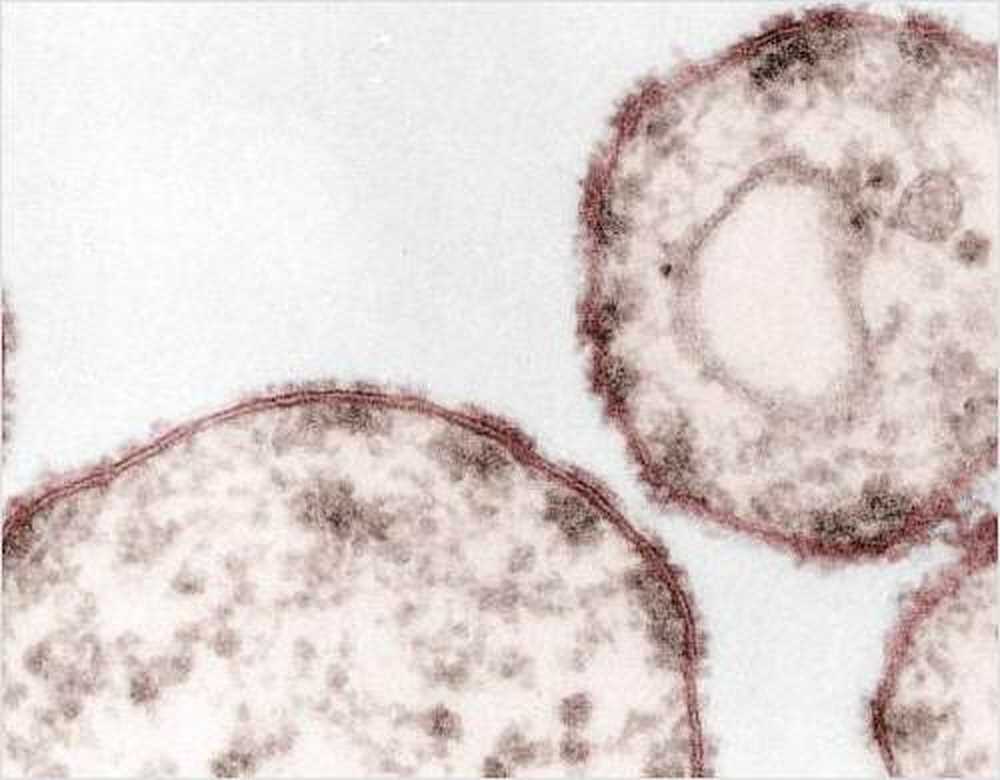 Allemagne le nombre de cas de rougeole augmente / Nouvelles sur la santé