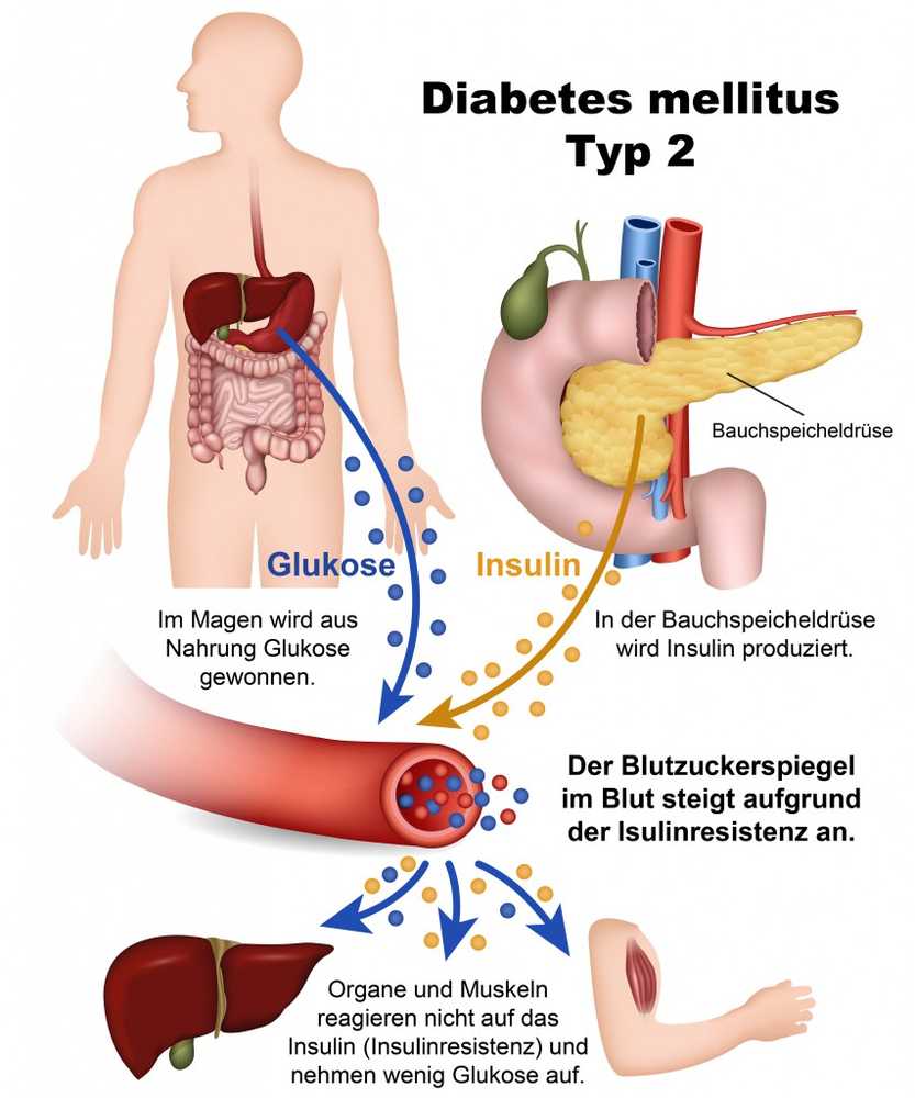 Diabetes - signs, causes and treatment