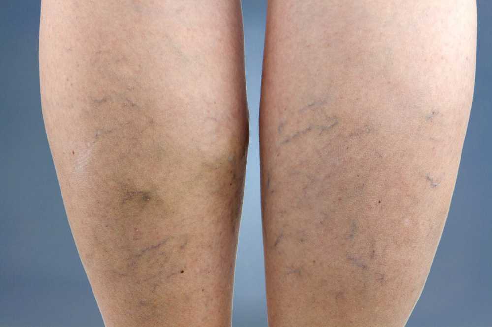 Thick legs due to venous disease / 