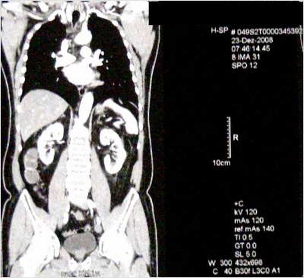 Diverticulitis Nueva terapia para la enfermedad intestinal. / Noticias de salud