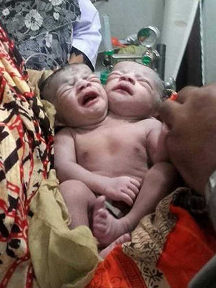 Een Siamese tweelingbaby met twee hoofden geboren in Bangladesh / Gezondheid nieuws