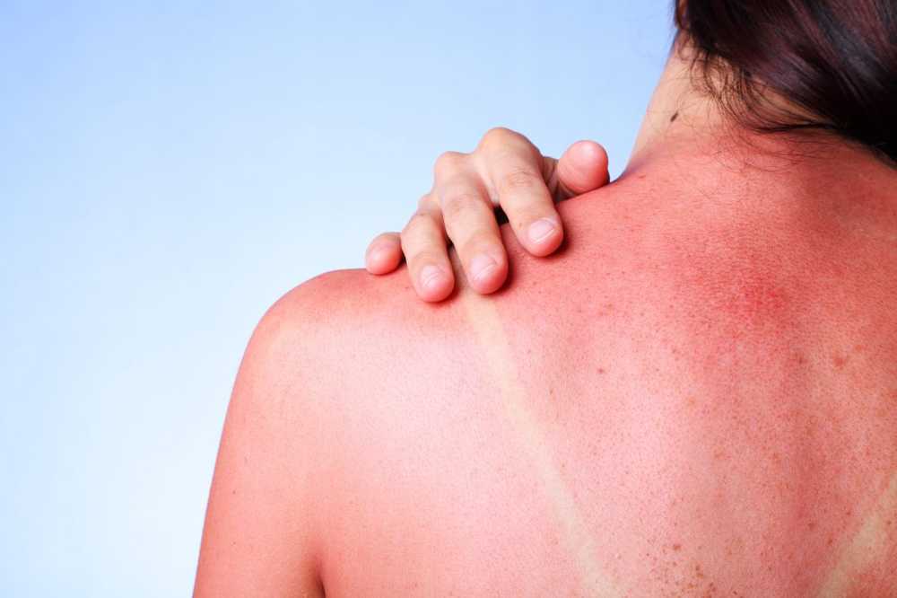 Simple but effective natural home remedy for sunburn / Health News