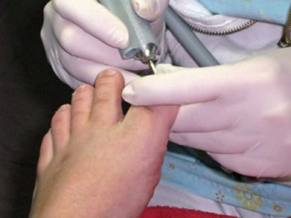 Ingrown toenail