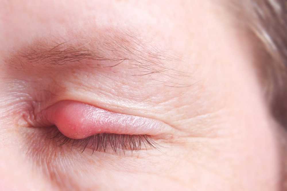 Inflammation of the eyelid Barley grain / Diseases