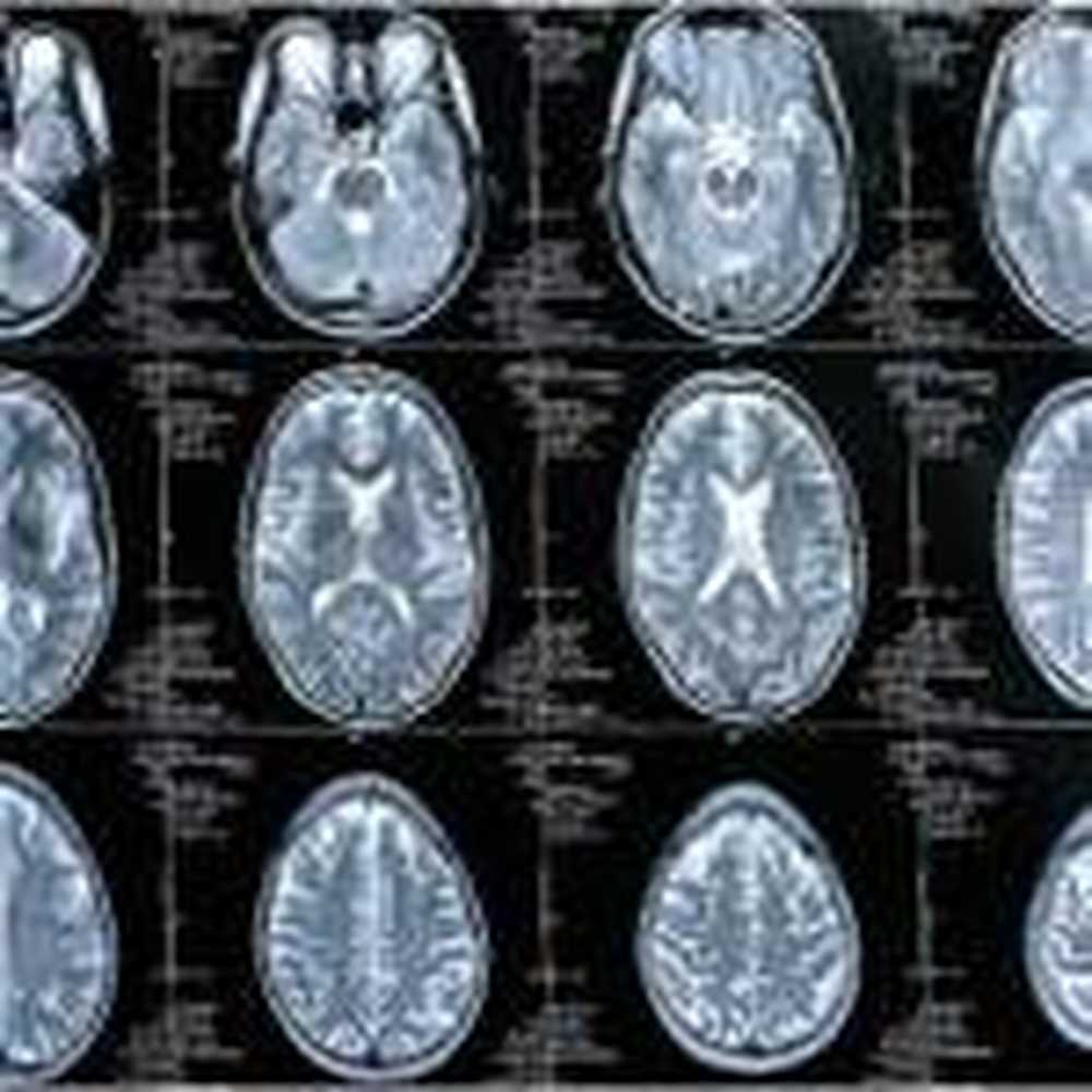 Sindrome da stanchezza riconoscibile nel cervello / Notizie di salute