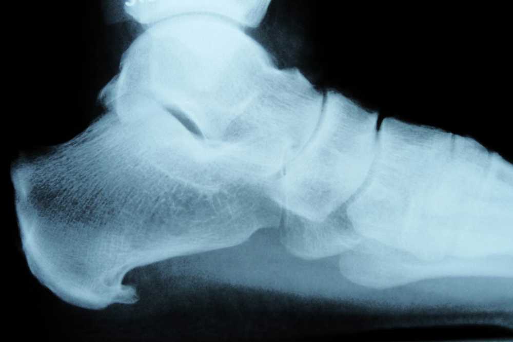 Heel spur - bone outgrowth on the foot bones / Diseases