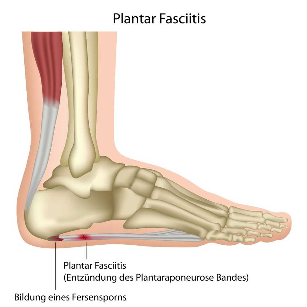 Heel spur pain with stinging at all steps / Health News