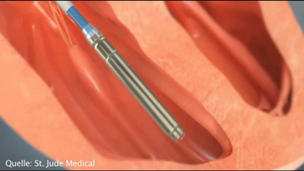 Researcher New pacemaker makes surgery unnecessary