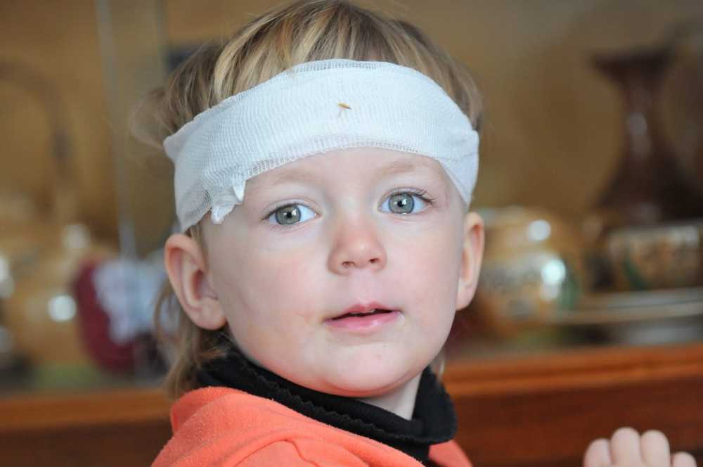 Researchers Even minor head injuries in children can lead to early death / Health News