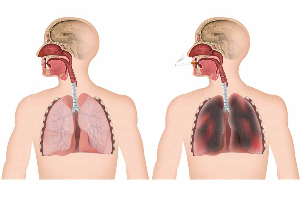 Femeile Mai multe decese cauzate de cancer pulmonar decât de cancerul de sân / Știri despre sănătate