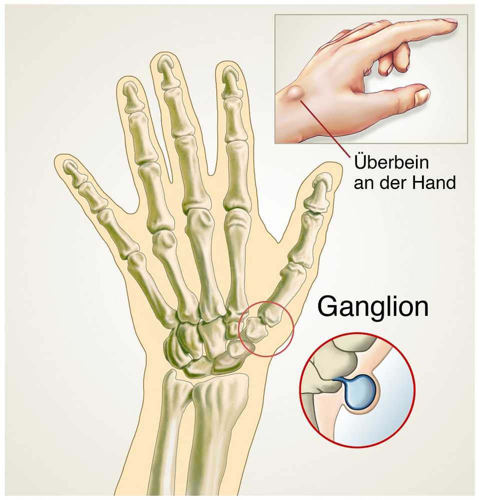 Ganglio Cosa può aiutare con una gamba al polso? / Notizie di salute