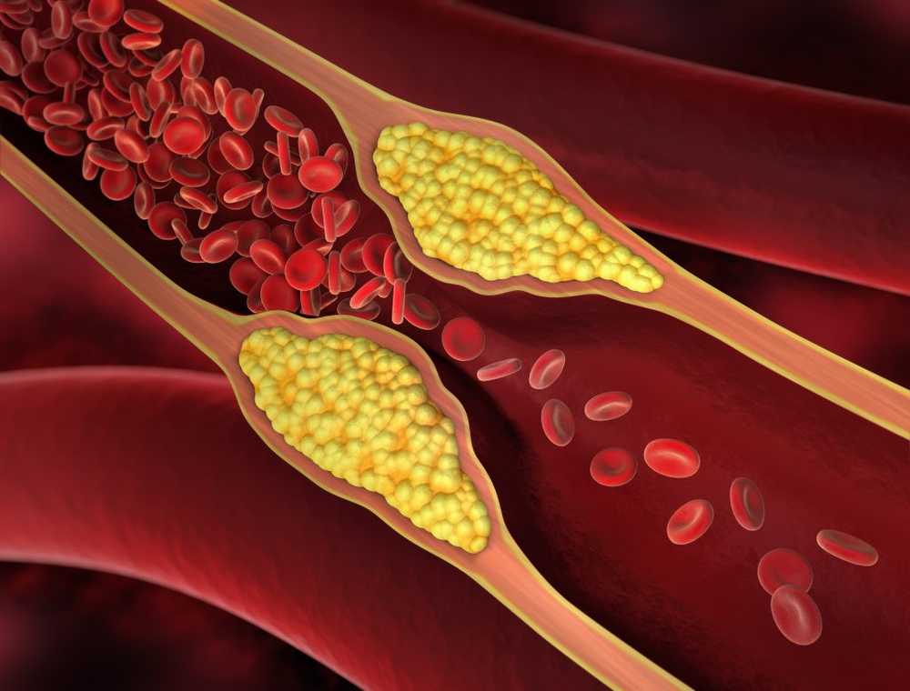 Vascular calcification Omega-3 fatty acids are effective in vascular calcifications / Health News