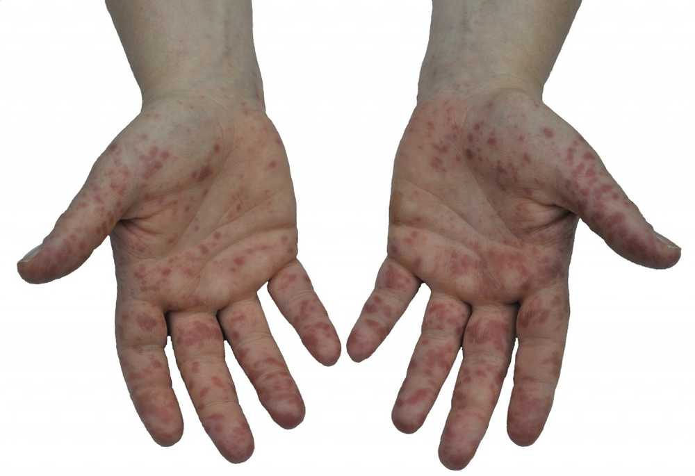 Hand-foot-and-mouth disease Drink plenty and help cool food / Health News