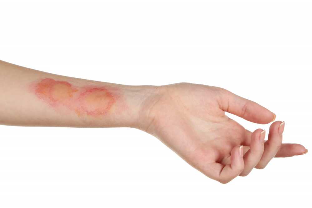 Home remedies for burns / 