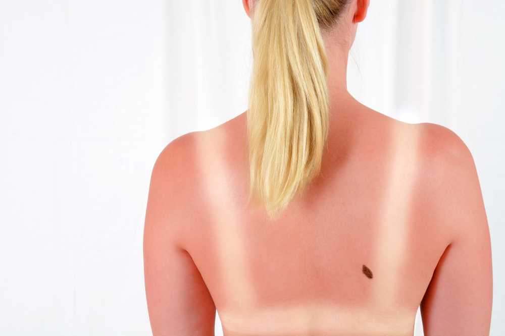 Light or dark? - When sunbathing, it always depends on the skin type / Health News