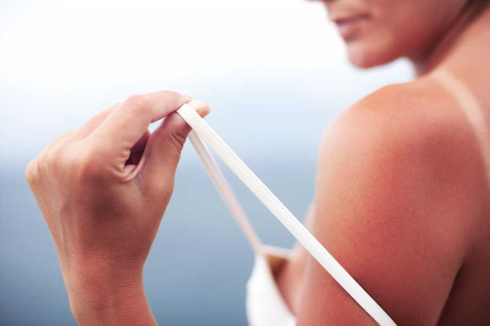 Helpful home remedies for sunburn / Health News