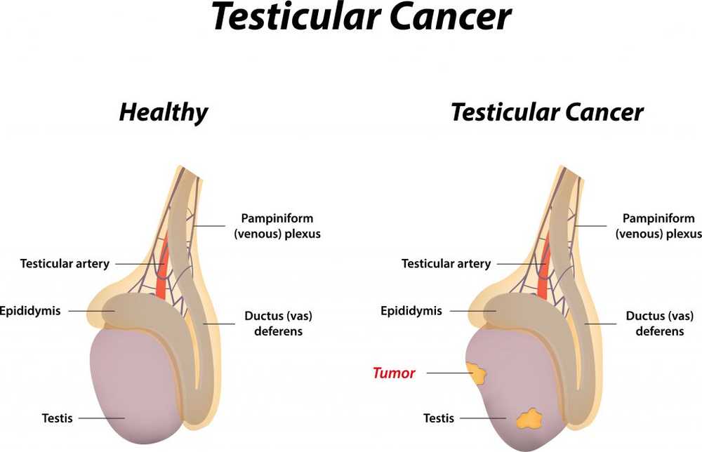 More and more testicular cancer due to mobile phone radiation?