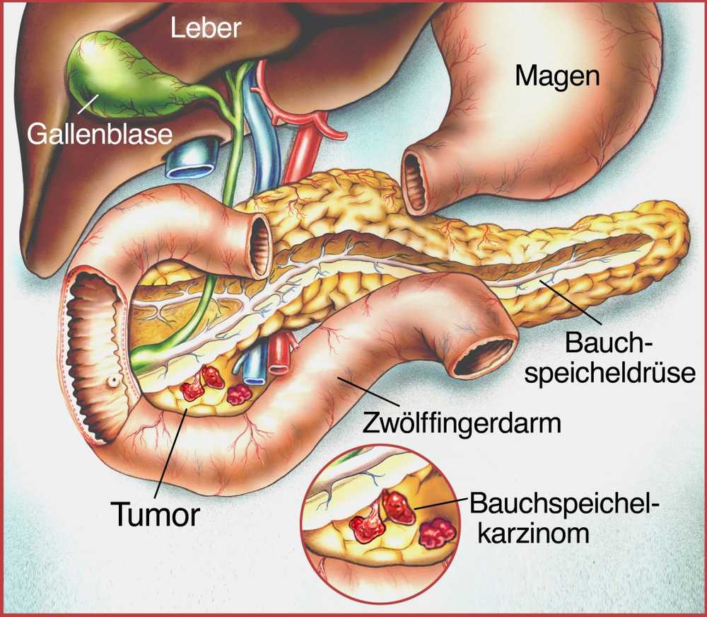 Individual treatment improves chances of recovery in a pancreatic cancer / Health News