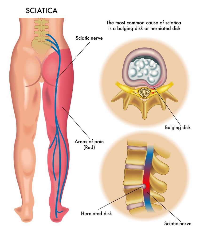 durerea de șold a prins nervul în dureri severe la genunchi în repaus