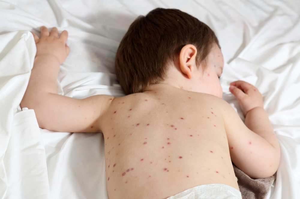 Knots on the skin Important to chickenpox / Health News