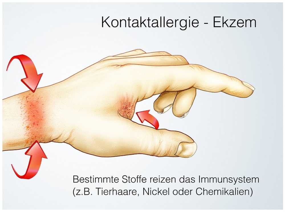 Contact allergie door nikkel Meer gezondheidsrisico's dan eerder bekend / Gezondheid nieuws