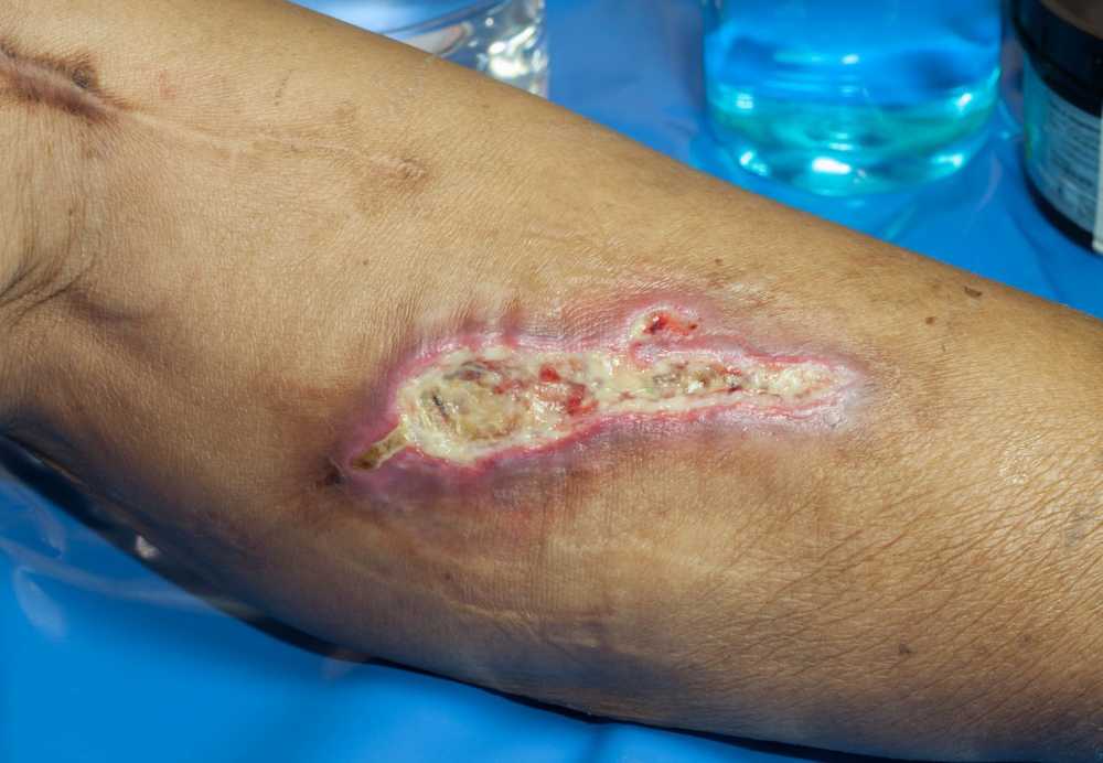 Cancer-causing parasite can promote wound healing? / Health News