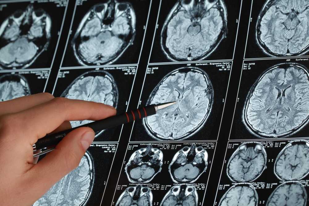 Ricercatori sul cancro I tumori al cervello hanno bisogno di grasso per la crescita / Notizie di salute