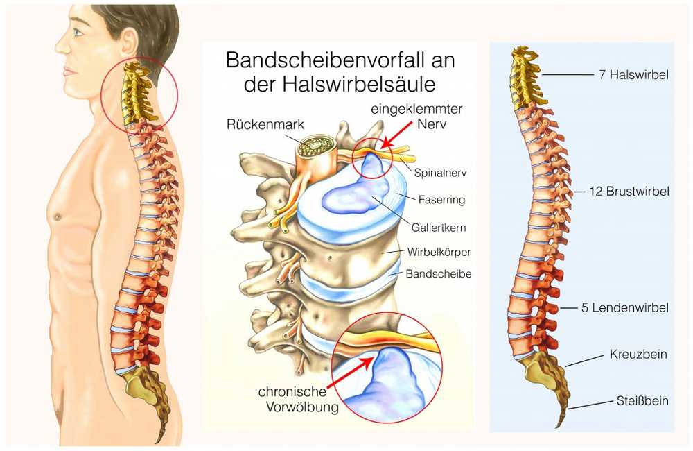 Back pain always be serious Take a herniated disc can be a medical emergency / Health News