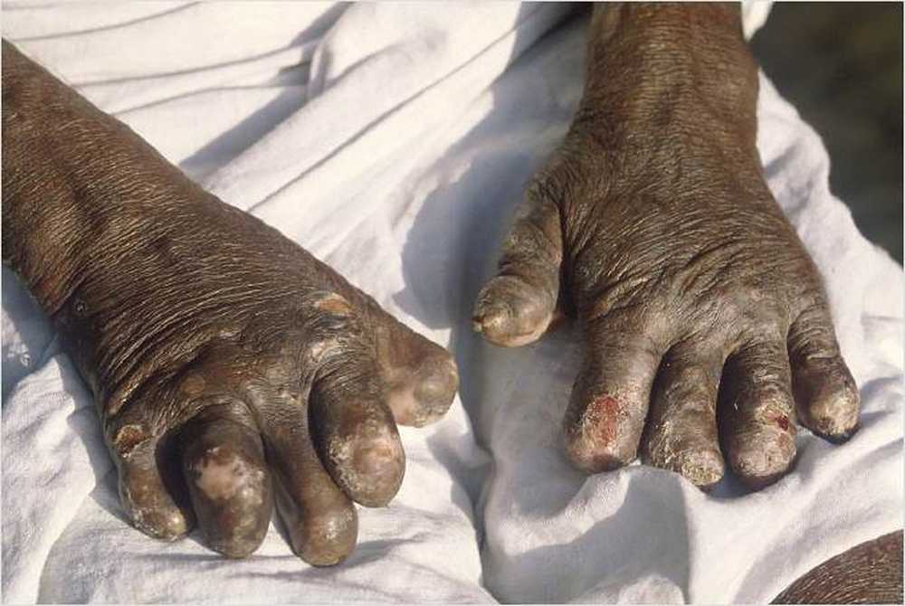 Leprosy En fattigdomssykdom / Helse Nyheter