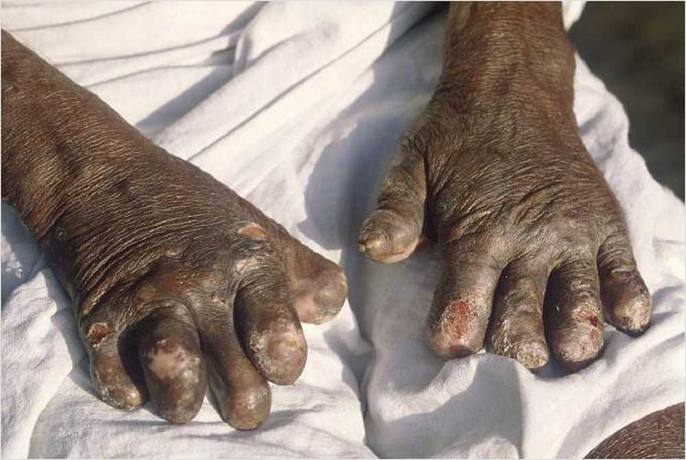 Leprosy is a disease of the poor / Health News