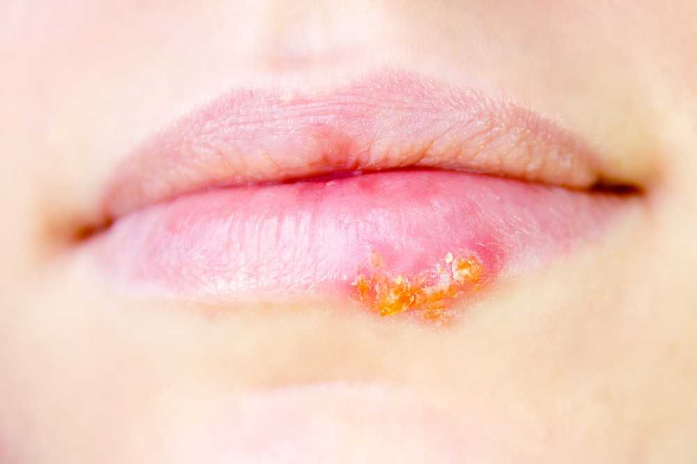 Herpes labiale Evitare di toccare le vesciche / Notizie di salute