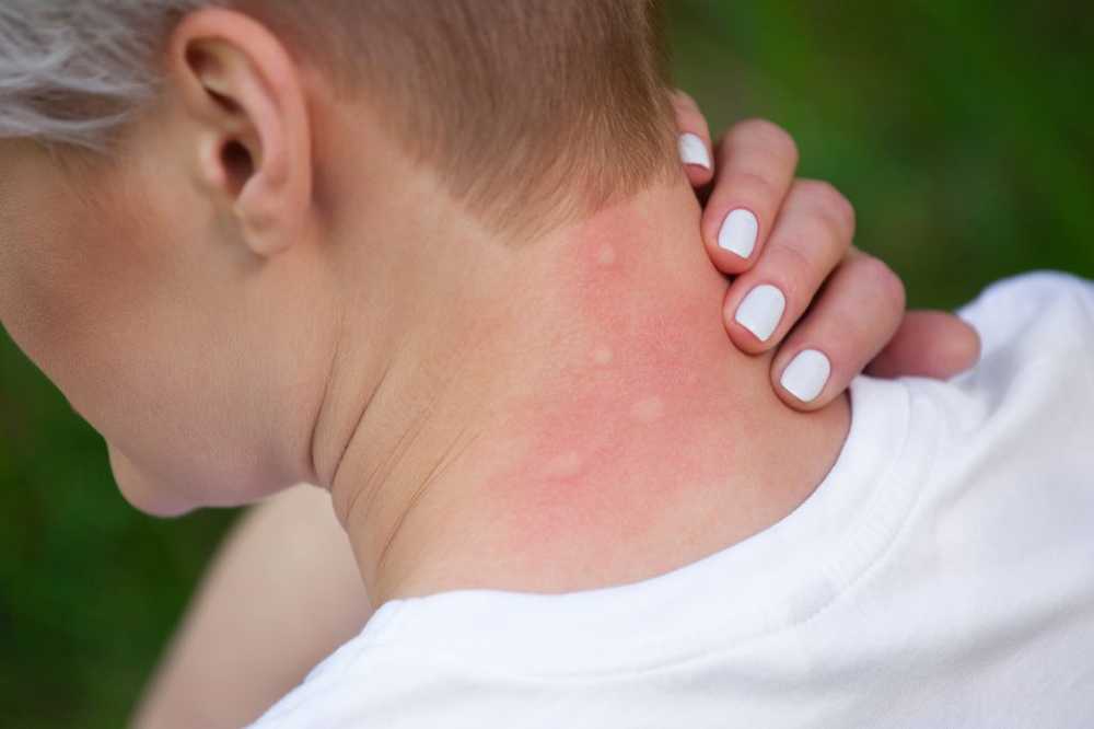 Gonflement douloureux dû aux ruches dépendantes de la pression / Nouvelles sur la santé