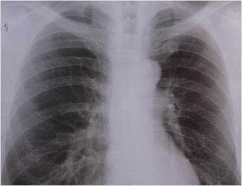 Cancerul pulmonar ucide mai multe femei decât cancerul de sân / Știri despre sănătate