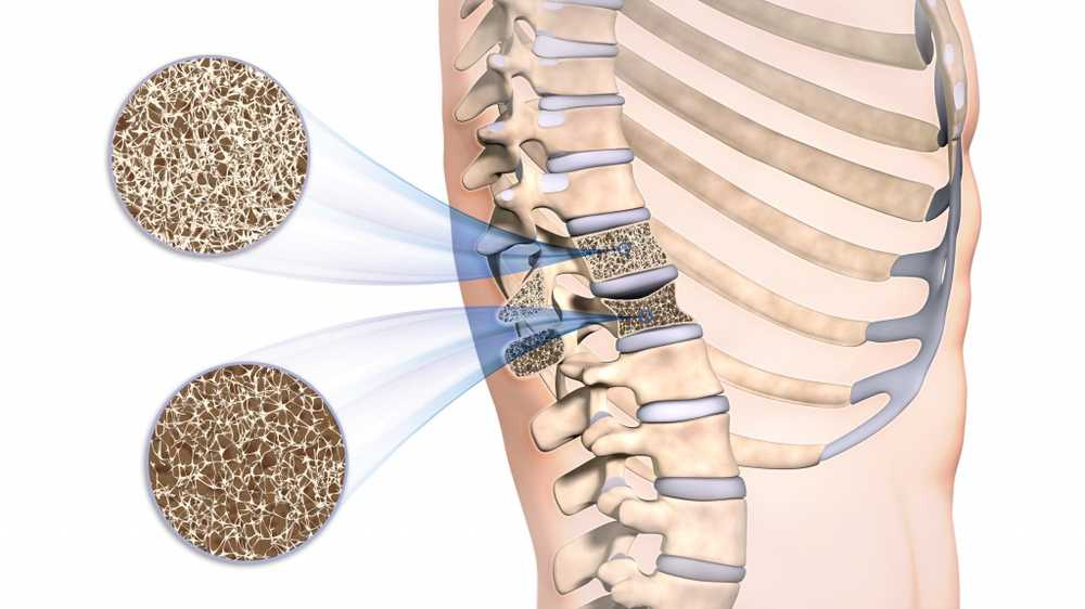 M. Bechterew osteopati forbedrer mobiliteten / Helse Nyheter