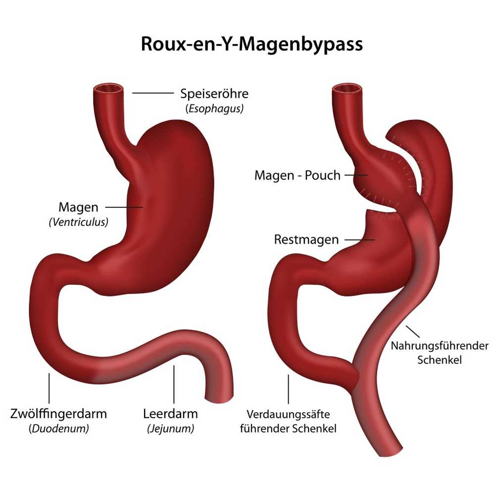 Gastric surgery increases suicide risk in patients with gastric bypass / Health News