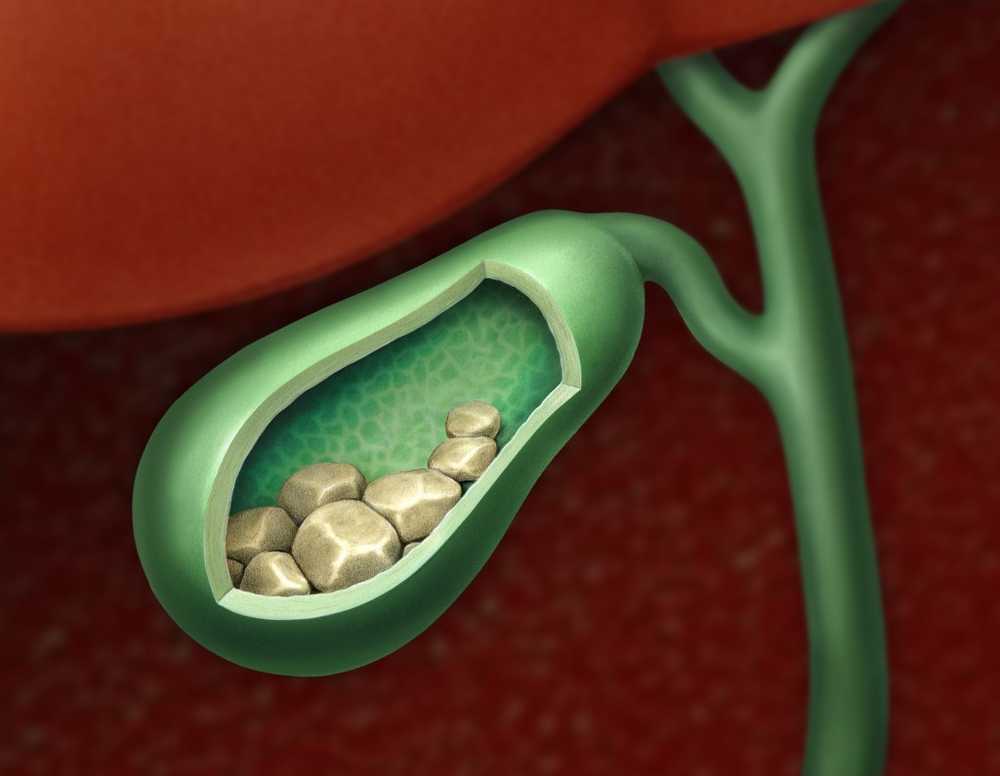 Massieve pijn van galstenen Bijna altijd is een operatie vereist / Gezondheid nieuws