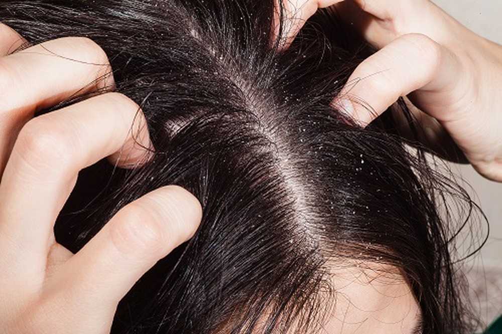 Massive dandruff multiplication by specific bacteria / Health News