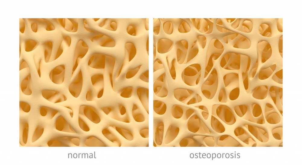 Miljoner äldre människor lider av osteoporos / Hälsa nyheter