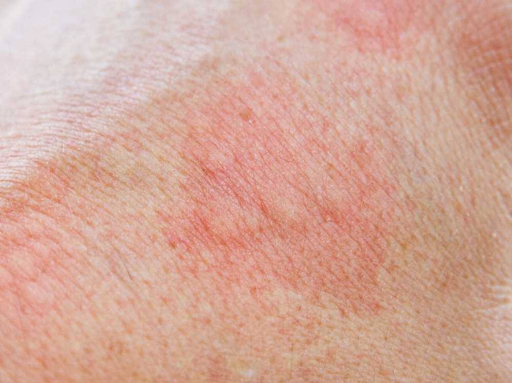 nettle rash / symptoms