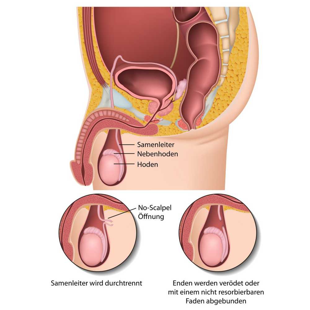 New method of contraception effective? Valve allows sperm at the touch of a button / Health News