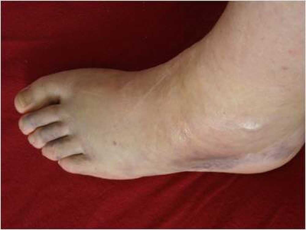 Often lymphedema after cancer therapy / Health News