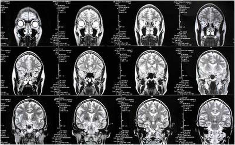 Patients control hand prosthesis through thoughts / Health News