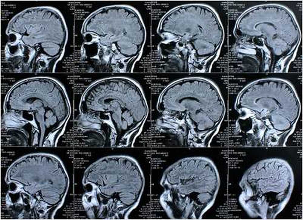 La psicoterapia sta cambiando il nostro cervello / Notizie di salute