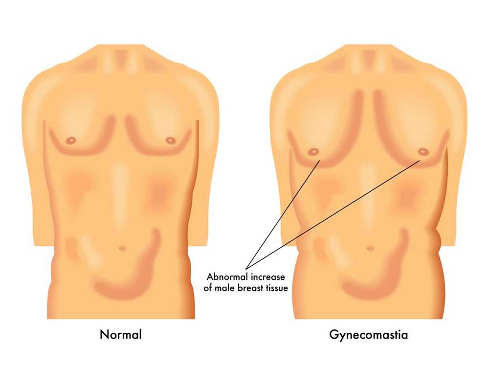 Puberteit gynaecomastism Mannelijke borsten