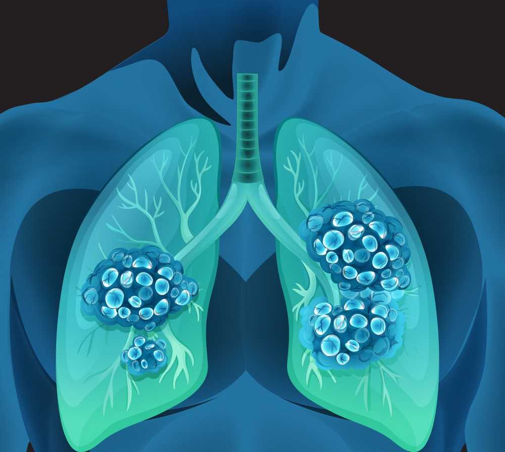 Resistance of lung cancer cells to chemotherapy decrypted / Health News